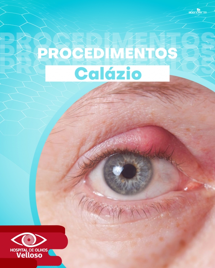Procedimentos - Calázio