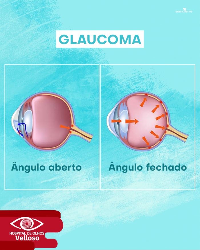 Glaucoma