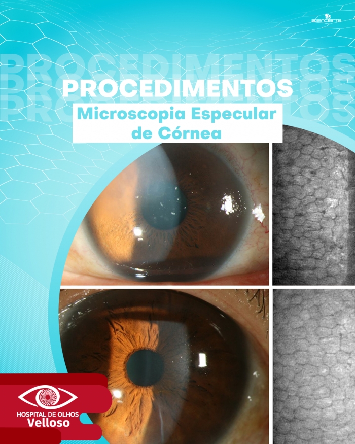 Procedimentos - Microscopia especular de Córnea