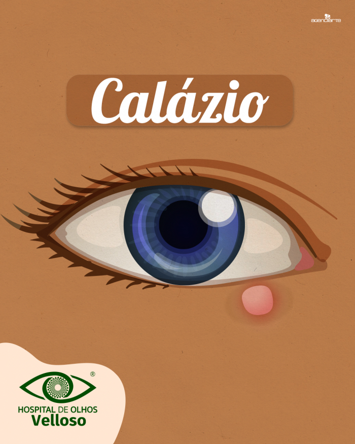 Calázio é uma lesão da pálpebra frequentemente confundida com terçol.