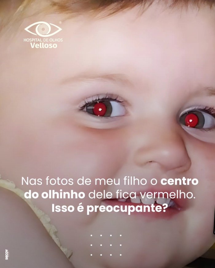 O reflexo nos olhos em fotos pode revelar sinais importantes sobre a saúde ocular infantil