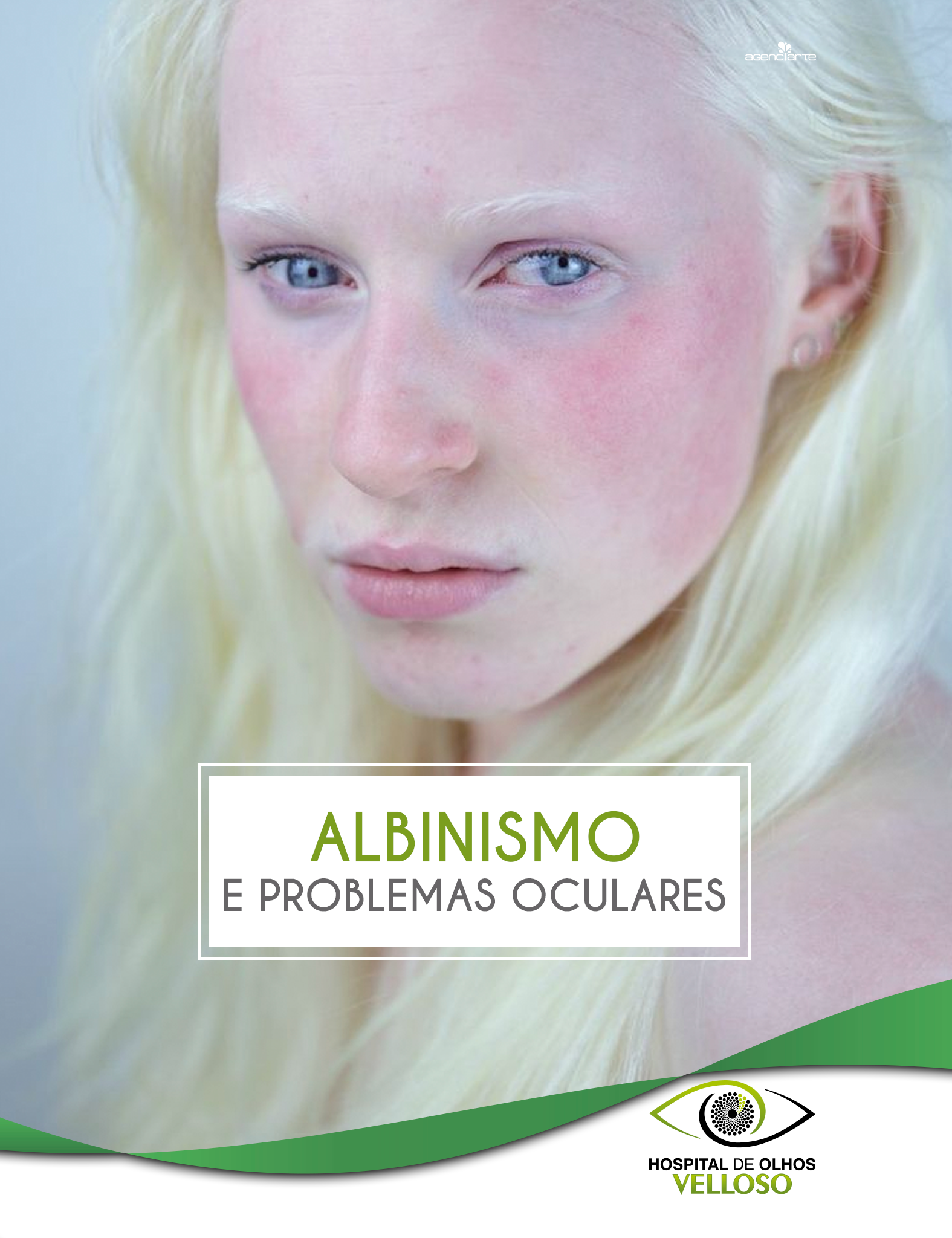 ALBINISMO E PROBLEMAS OCULARES