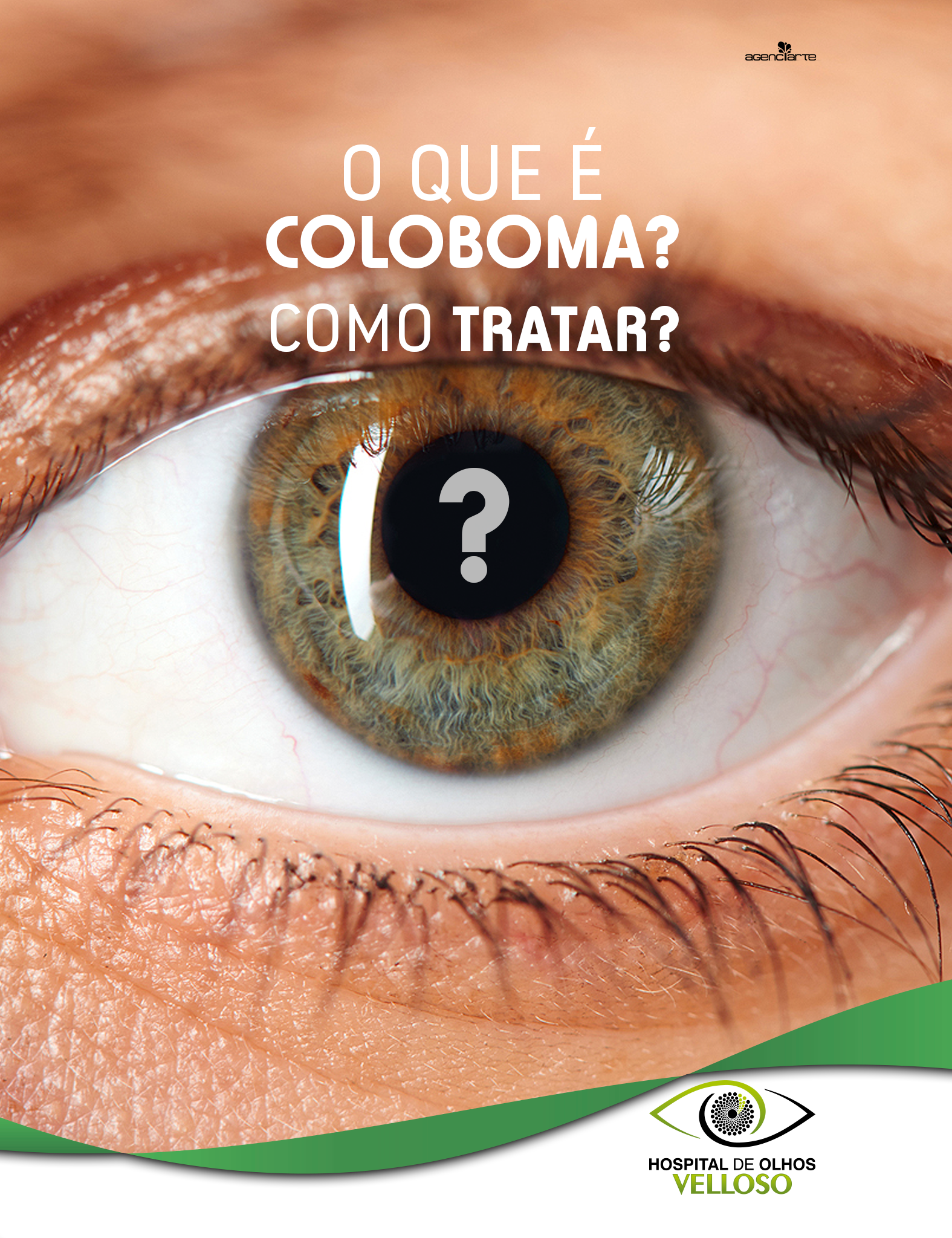 O QUE É A COLOBOMA OCULAR E COMO TRATAR