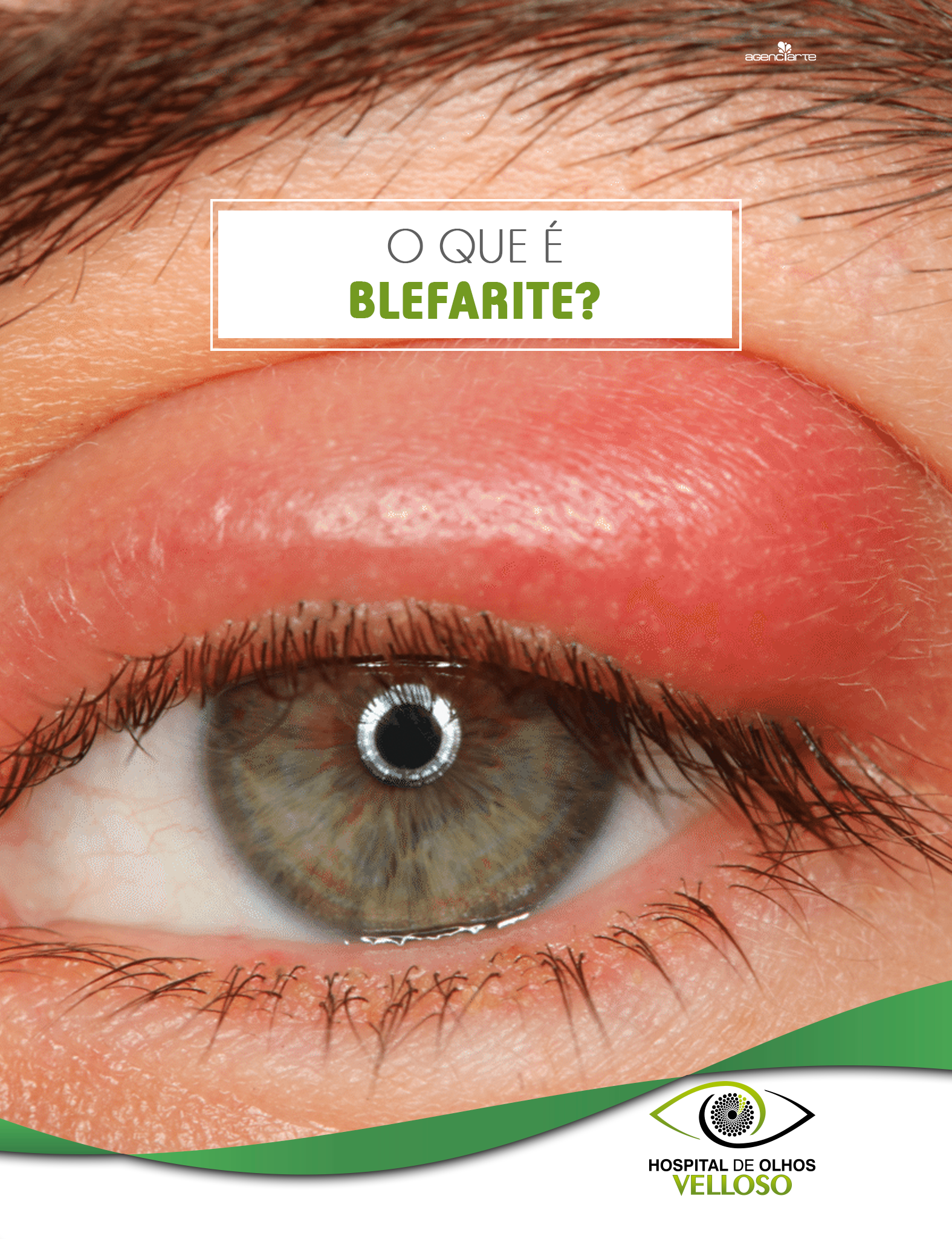 O QUE É BLEFARITE?