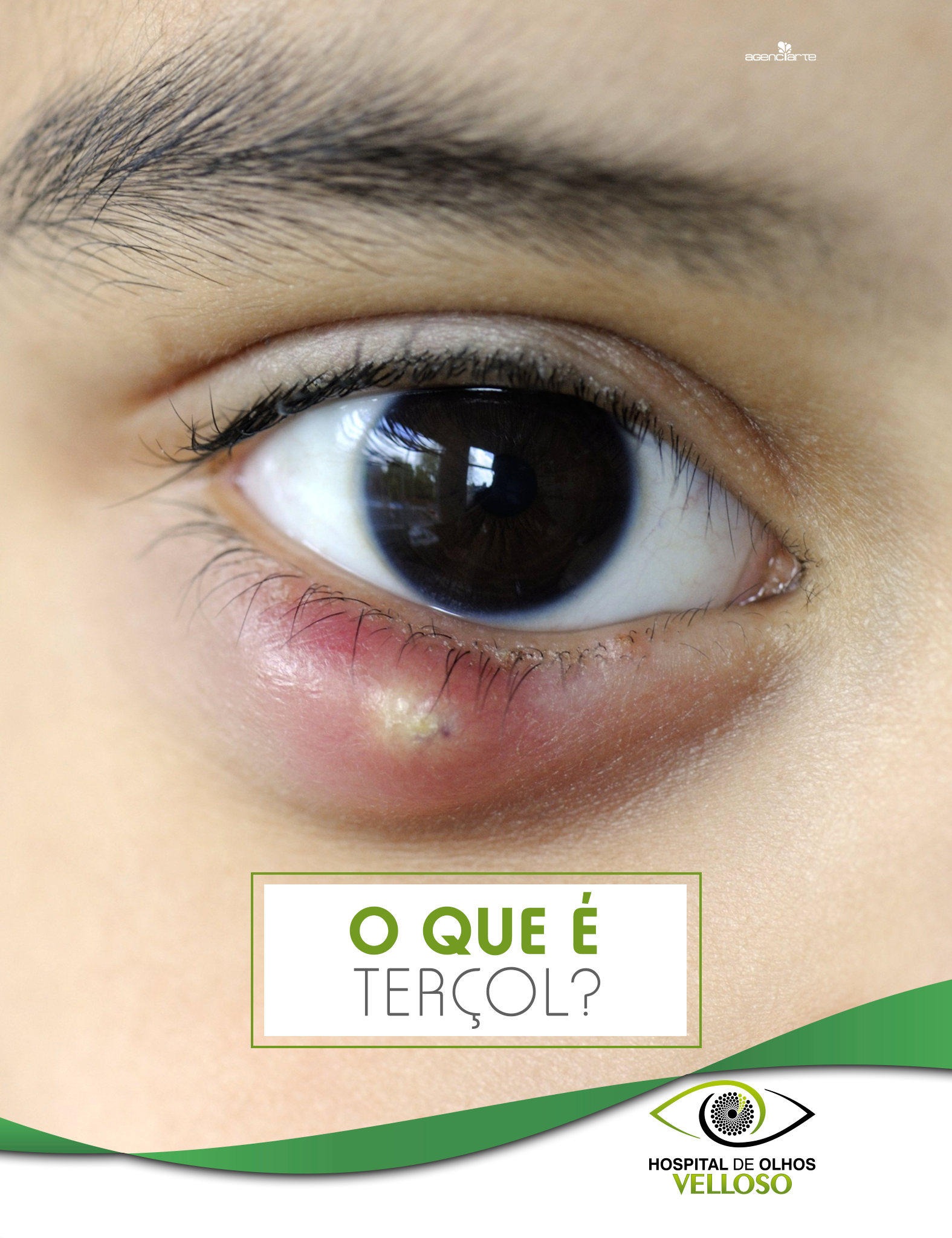 O QUE É TERÇOL?